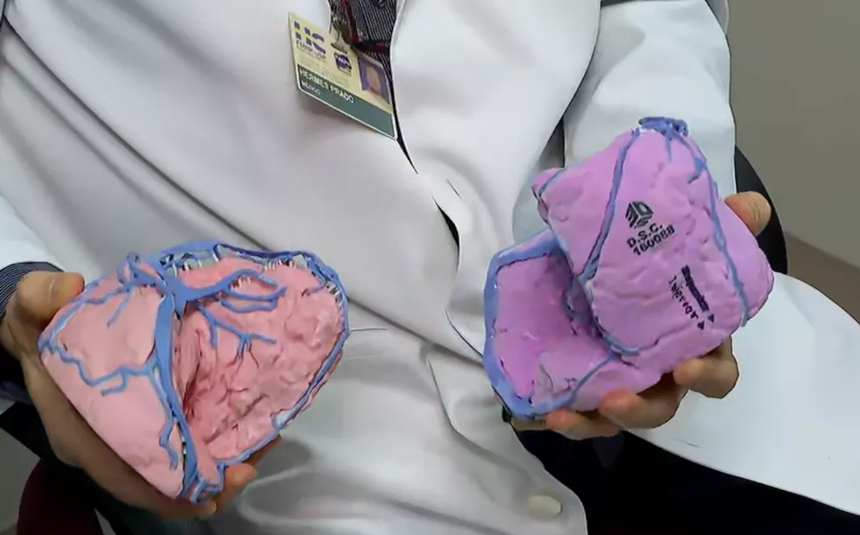 Imagem da impressão 3D dos cérebros dos gêmeos, para auxiliar a equipe médica na cirurgia.