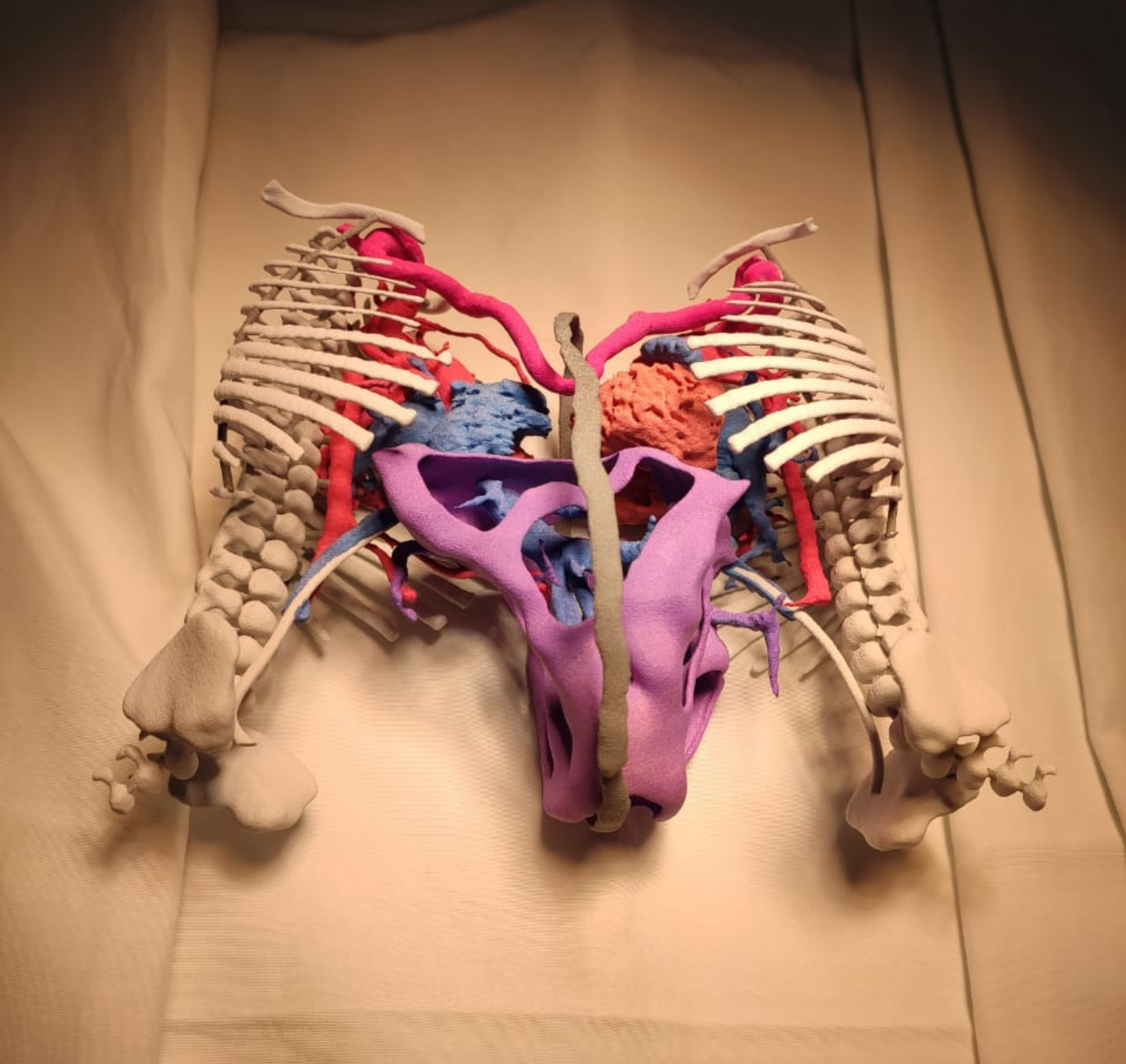 Como a tecnologia de impressão 3D ajudou em cirurgia de siameses e pode ser decisiva na área médica